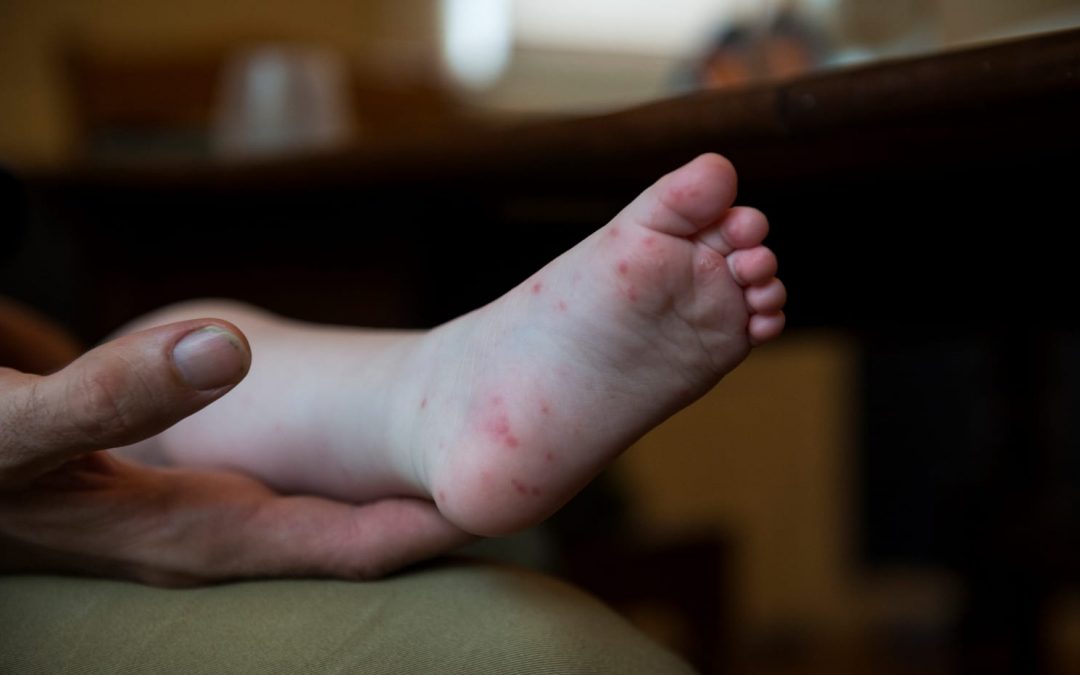Warning For Hand, Foot & Mouth Disease