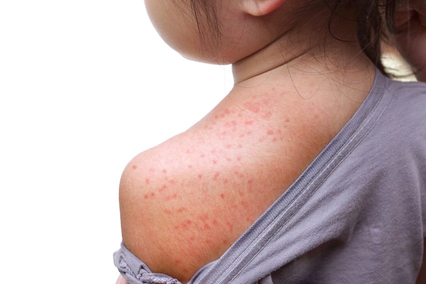 Health Ministry: No Measles Outbreak In Barbados